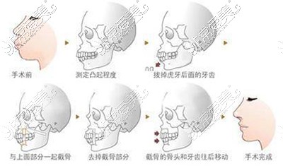 正颌手术费用一般是多少钱?专业分析正颌手术需要多少钱!