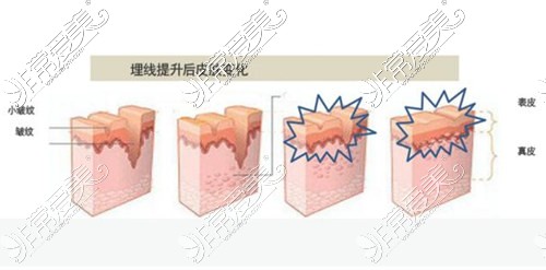 埋線提升后皮膚變化示意圖