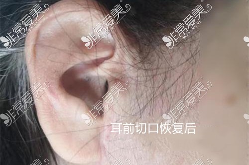 无痕水剥离拉皮手术耳前切口恢复图