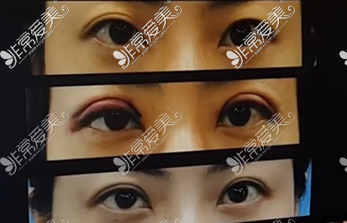 双眼皮不对称修复日记