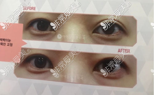 双眼皮不对称修复
