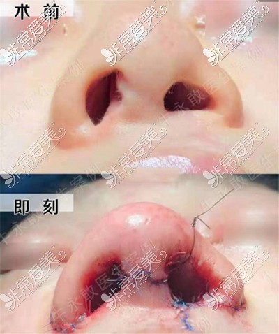 牛永敢唇腭裂修复