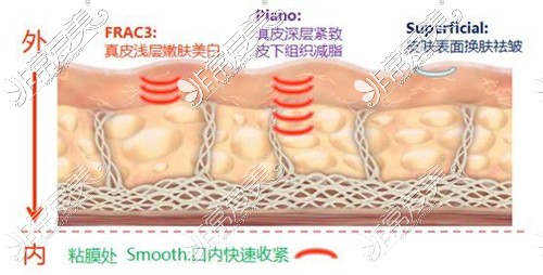 欧洲之星Fotona4Dpro四大模式