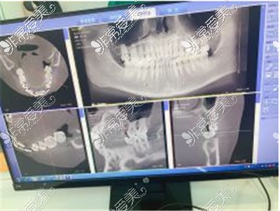 临沂银座牙客口腔CT