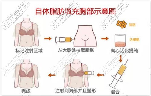 南宁韩成自体脂肪填充胸部示意图