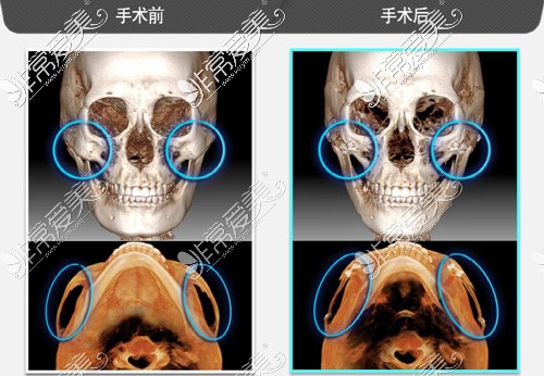 骨骼变化影响衰老