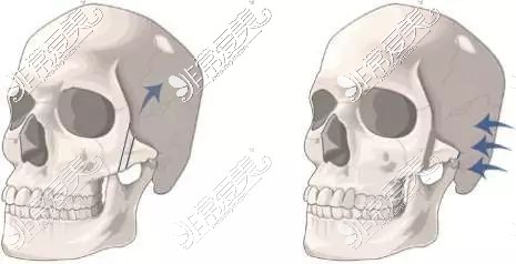 颧骨截骨内推