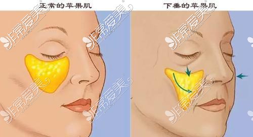 颧骨苹果肌下垂对比