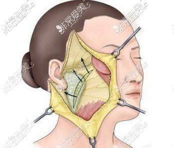 面部拉皮手术