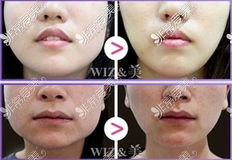 韩国WIZ&美整形外科瘦脸针案例
