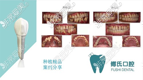 义乌傅氏口腔种植牙<span style=