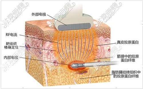 射頻溶脂原理
