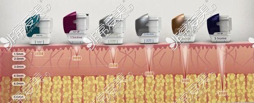 7d聚拉提不同探头作用到皮肤层深度