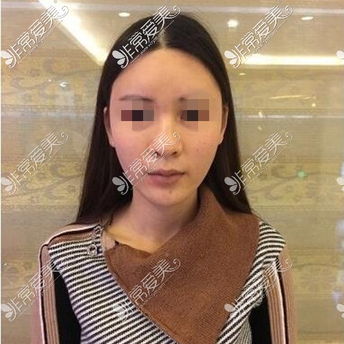 郑州缔莱美孟庆鹏做鼻子怎么样?