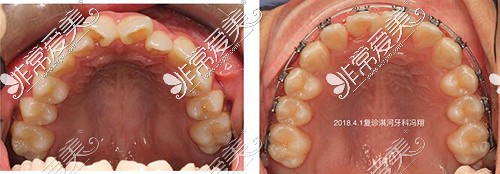 鹤壁淇河牙科金属正畸照片