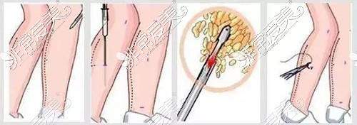 腿部吸脂過程