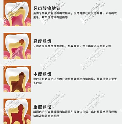 牙齿龋坏的演变过程