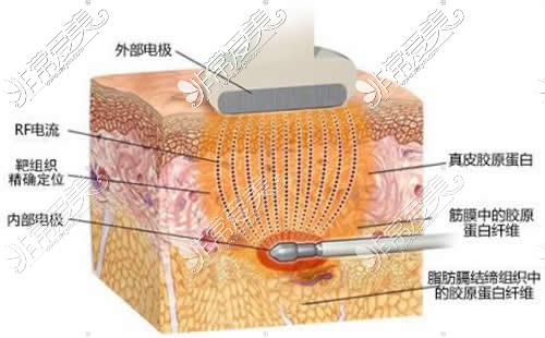 射頻溶脂瘦臉原理分析