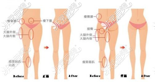 宁波大腿抽脂医院