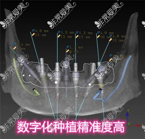 数字化种植牙和传统种植牙区别对比!细数数字化种牙优缺点