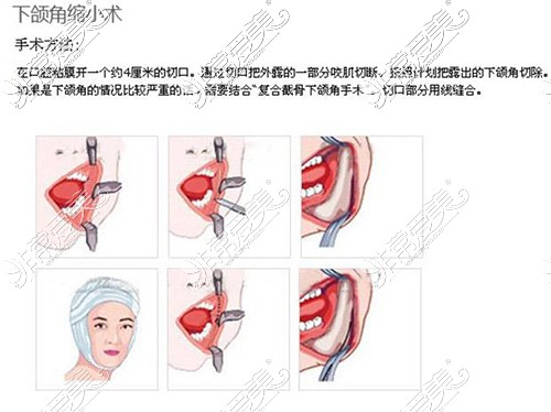 磨骨手术从哪里开刀口?带你深入了解磨骨手术怎么进行的!