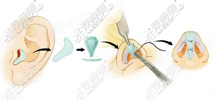 耳软骨隆鼻过程
