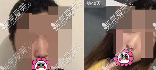 哈尔滨哪家做鼻综合做的好?肋骨鼻综合出名的医院医生测评