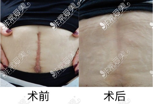 广州新#2Y*&x*b剖腹产疤痕祛除<span style=