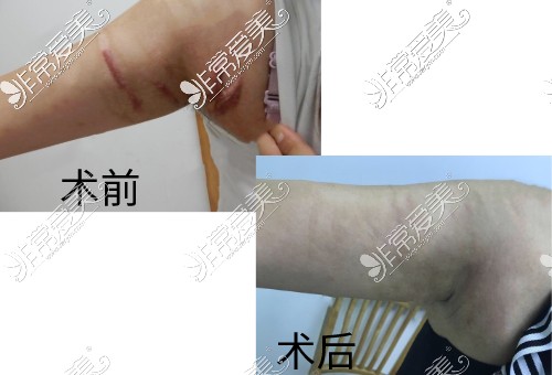 广州药#2Y*&x*b学第三#2Y*&x*b医院祛疤<span style=
