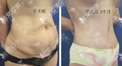 首尔slim外科医院腹部赘皮去除术图片