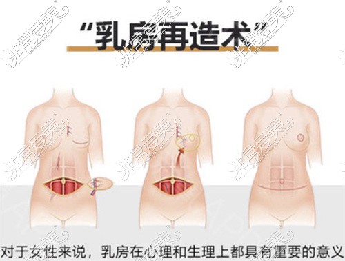 乳房再造假体和自体哪个好?价格术式各方面分析您适合哪种!