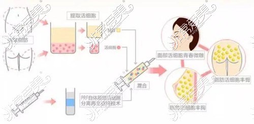 国内自体脂肪填充哪些医生好