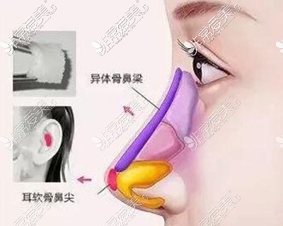 隆鼻卡通示意图照片