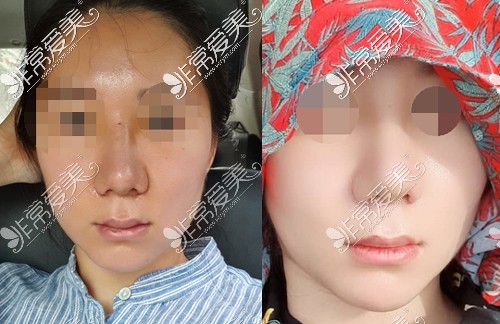 鼻翼缩小手术后效果