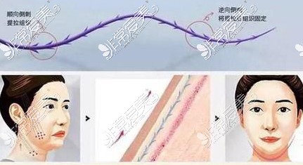 面部埋線提升示意圖