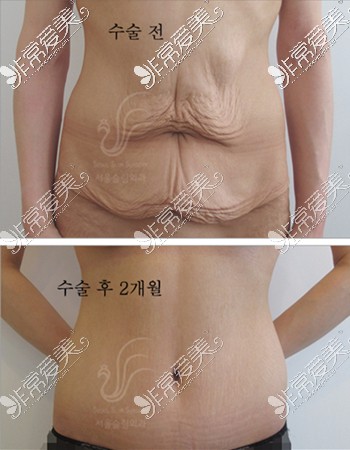首尔slim外科腹部赘皮切除手术图片