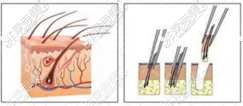 毛发种植医院