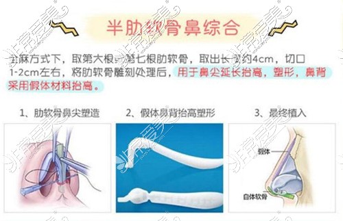 全肋骨鼻好还是半肋骨鼻好?山东济宁哪里做肋骨鼻技术好?