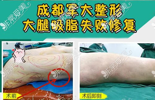 大腿吸脂凹陷修复成功照片、吸脂凹凸不平修复方法曝光！