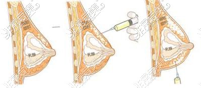 自体脂肪丰胸过程