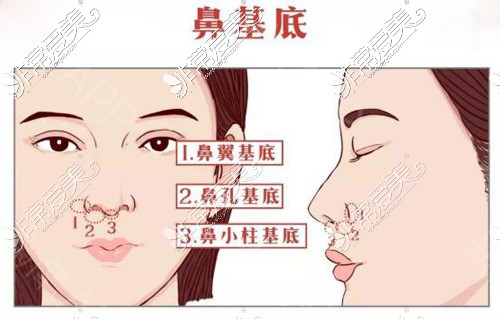 填充鼻基底改善隆鼻
