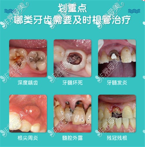 需要做根管治疗的情况