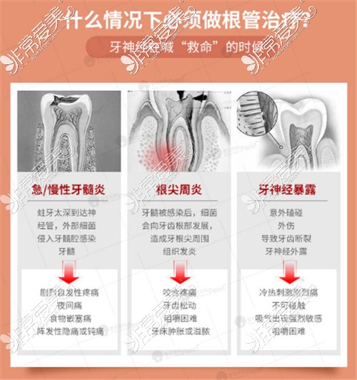 需要做根管治疗的现象