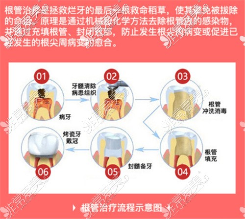 根管治療介紹圖