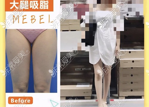 大腿吸脂效果图