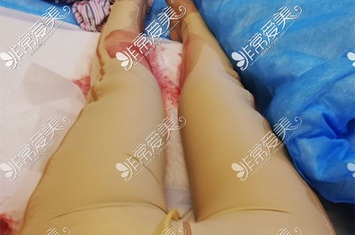 大腿吸脂术后渗液渗出