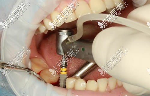 青岛地区种植牙手术介绍