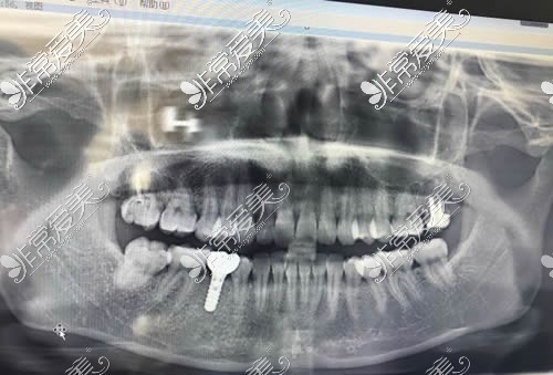 青岛地区种植牙术后CT图