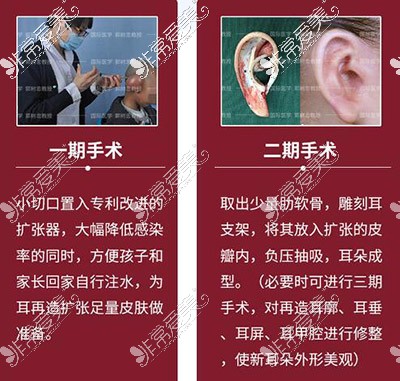 耳再造手术二期手术示意图
