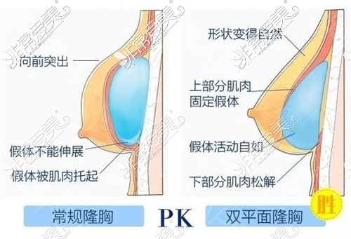 武汉曼托隆胸价格公布,武汉隆胸手术好的医院报价汇总!